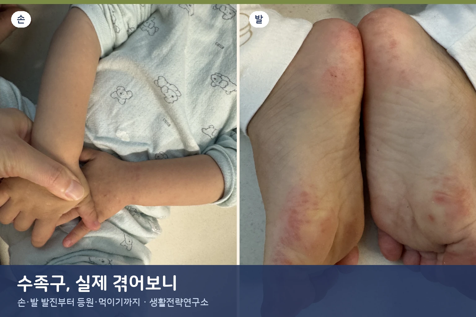 수족구 실제 겪어보니 – 구내염과 뭐가 다를까? 손발 사진·등원·먹이기 총정리 (엄마 후기)